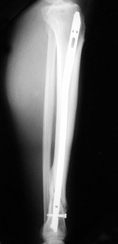 Tibia, Shaft:  Synthes Titanium Nail (Implant 230)